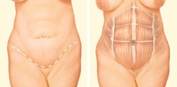 Tummy Tuck Denver Procedures