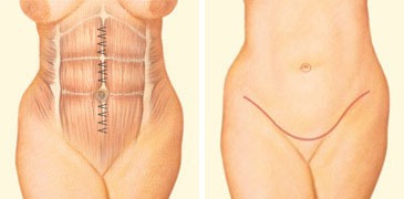 Tummy Tuck Denver Procedures
