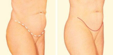 Tummy Tuck Denver Procedures